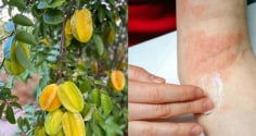  Mách mẹo làm giảm rôm sảy, mẩn ngứa bằng lá khế: Dân gian dùng nhiều nhưng cần biết đúng cách