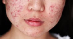 Căng thẳng kéo dài có thể khiến mụn trứng cá dai dẳng và khó kiểm soát