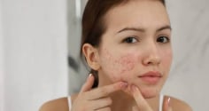 7 loại mặt nạ thiên nhiên hỗ trợ làm mờ thâm mụn, giúp da sáng khỏe tại nhà