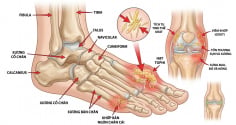 Acid uric tăng cao: 5 biểu hiện dễ bị bỏ qua, nhiều người chỉ phát hiện khi gout đã xuất hiện
