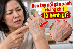 Bàn tay nổi gân xanh chằng chịt là bệnh gì?