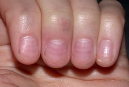 Nhìn móng tay bắt bệnh cực kỳ chính xác