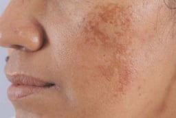 Bạn bị đốm đồi mồi, tàn nhang thường là do 3 điều này, hãy chủ ý đển chúng để có làn da đẹp
