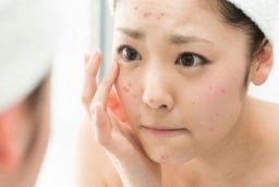 Cách xử lý và chăm sóc da khi bị kích ứng mỹ phẩm