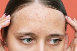 Nhận diện sẹo rỗ và 5 phương pháp cải thiện giúp làn da dần mịn màng hơn