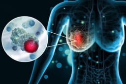 5 dấu hiệu ung thư vú giai đoạn 1: Phát hiện sớm có thể kéo dài sự sống