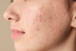 5 cách giúp giảm mụn cám tại nhà, hỗ trợ da thông thoáng và mịn màng hơn