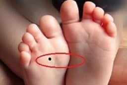 4 nốt ruồi trên chân mang tới may mắn cho bạn: Ai có thật đáng chúc mừng