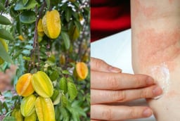  Mách mẹo làm giảm rôm sảy, mẩn ngứa bằng lá khế: Dân gian dùng nhiều nhưng cần biết đúng cách