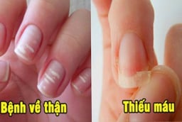 Bắt bệnh qua móng tay: Có 1 dấu hiệu cũng nên đi khám sớm