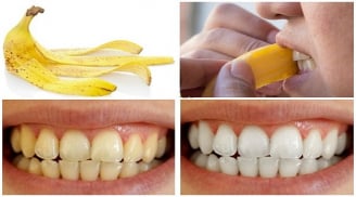 Loại bỏ 99% mảng bám cao răng đơn giản trong tích tắc nhờ sử dụng vỏ chuối theo cách này