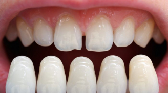 6 triệu chứng bất thường ở răng miệng cảnh báo nhiều vấn đề nguy hại, đặc biệt là cái số 1