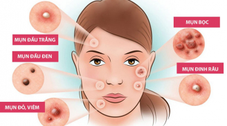 5 nguyên nhân chẳng ngờ đến khiến mụn cứ mọc đi mọc lại ở cùng một vị trí, bất ngờ với số 3