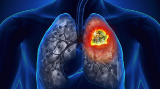 Dấu hiệu ‘ba đen, hai đau’ cảnh báo phổi đang tổn thương nặng nề, cần đi gặp bác sĩ ngay lập tức