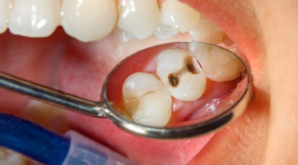 Thấy răng xuất hiện điểm 'lạ' này cần đi kiểm tra càng sớm càng tốt, chớ vội coi thường