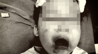 Nghịch cắn dây điện, bé gái 2 tuổi bị bỏng nặng vùng miệng