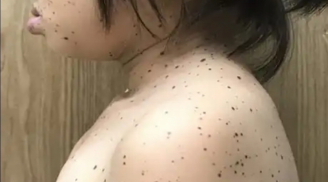 Bé gái đầu tiên ở Việt Nam xuất hiện hội chứng da báo: Nguyên nhân và cách điều trị thế nào?