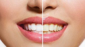 Đánh răng mỗi ngày nhưng răng vẫn ố vàng: Nguyên nhân do đâu?