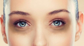 Thâm quầng mắt là dấu hiệu của 5 vấn đề sức khỏe chớ nên bỏ qua