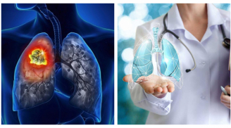 2 vợ chồng cùng mắc K phổi do thói quen tại hại của người chồng: BS chỉ cách bảo vệ lá phổi của bạn