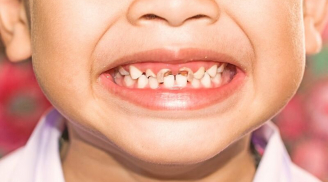 7 bệnh răng miệng thường gặp nhất ở trẻ, cha mẹ tuyệt đối không thể “làm ngơ”