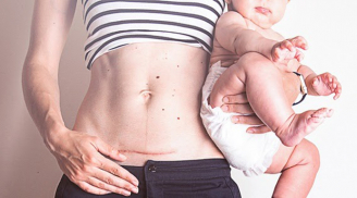 6 trường hợp mẹ bầu nên chọn biện pháp sinh mổ thay vì sinh thường