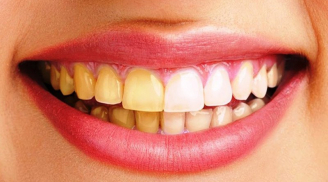 4 loại thực phẩm càng ăn càng khiến răng ố vàng, cố tẩy trắng cũng vô ích