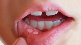 Thường xuyên viêm loét miệng không thể chủ quan, để lâu không khỏi rất dễ K miệng