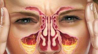 8 biện pháp giúp F0 giảm ngạt mũi, tránh tình trạng khô họng, đau họng