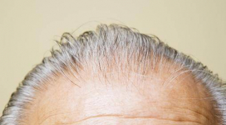 3 vị trí tóc bạc sớm có thể là dấu hiệu suy yếu của 3 cơ quan quan trọng, đừng chủ quan