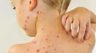 5 vấn đề ngoài da thường gặp ở trẻ sơ sinh, mẹ lưu ý để phòng ngừa và điều trị cho con