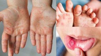 Số ca mắc tay chân miệng gia tăng: BS nói trẻ có 3 dấu hiệu này là bệnh nặng, cần cho đi viện ngay