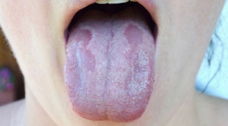 Lưỡi bỗng xuất hiện đốm trắng là dấu hiệu của bệnh gì? Trường hợp đặc biệt có thể là bệnh ung thư nguy hiểm