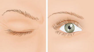 Liên tục nháy giật mắt có thể là lời cảnh báo sớm của 4 vấn đề bệnh tật