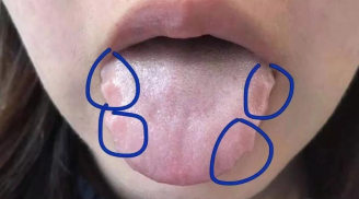 Lưỡi là 'thước đo' sức khỏe, thấy 4 dấu hiệu cảnh báo này thì đừng có chủ quan