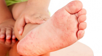 Lòng bàn chân có 4 dấu hiệu này chứng tỏ chức năng gan của bạn đang suy giảm, ai không có thật đáng mừng