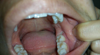 Có nên nhổ răng số 8 hay không? Biết điều này sớm kẻo nguy hại khó lường