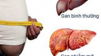 6 dấu hiệu rõ mồn một trên khuôn mặt cảnh báo gan nhiễm mỡ, đó là gì?