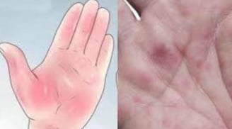 Thấy bàn tay có 1 trong 4 dấu hiệu: Cận thận K gõ cửa, số 2 nhiều người nhầm tưởng bệnh ngoài da