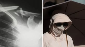 Một phụ nữ bị gãy xương do thói quen che nắng cẩn thận quá mức