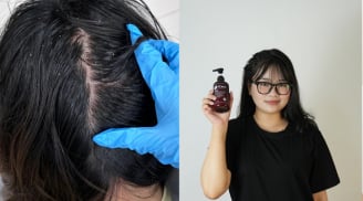 Trải nghiệm hết gàu ngứa của nữ sinh viên năm cuối: Kết quả bất ngờ từ dầu gội thảo dược?
