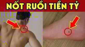 5 nốt ruồi Vàng thần Tài đánh dấu, sớm muộn cũng giàu