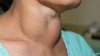 3 dấu hiệu lạ ở cổ, cảnh báo người sắp bị K tấn công