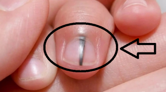 3 chỗ trên người chuyển màu đen báo tuổi thọ ngắn, số 1 nguy hiểm nhất