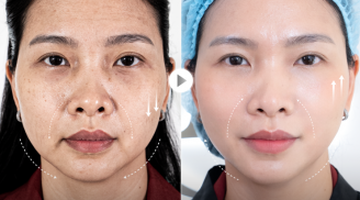 Căng da không phẫu thuật -Công nghệ 5.5.10: Vì sao trở thành xu hướng trẻ hóa được phụ nữ sau 40 tuổi lựa chọn?