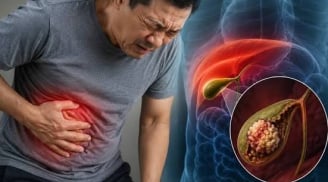 3 dấu hiệu cảnh báo viêm túi mật nặng