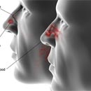 Chảy máu mũi: Coi chừng u xơ vòm mũi họng