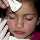 Bất chấp nguy hiểm, mẹ tự tiêm botox lên mặt cho con gái 8 tuổi