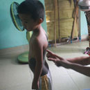 Bệnh lạ ở Quảng Nam: Cháu bé có lớp 'da trâu'