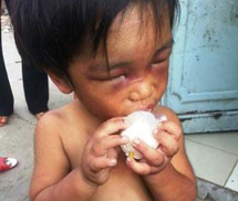 TP.HCM: Bé 3 tuổi bị mẹ và cậu đánh tím mắt